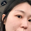 약초명가&스킨케어 | 천안 피부관리 “이정희 스킨케어” 약초필 후기 (여드름 피부 추천!)