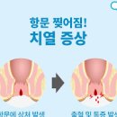 치열 및 법 (, 만성 / 항문 출혈 피부꼬리) 이미지