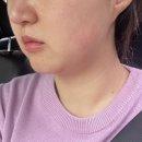 30대 이중턱관리 청담피부과 온다리프팅 소프웨이브 후기(통증,효과,비포에프터)