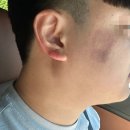 미미썸의원 김해점 | 김해 인모드 (FORMA, FX) &amp; 슈링크 후기