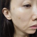 조은I의원 | 여의도 유스피부과 40대 5g리프팅 생생후기 (실리프팅 리프팅주사 페이스유스키니)