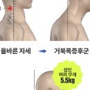 버섯증후군 원인 거북목 증후군 예방방법 이미지