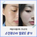 예쁨주의쁨의원 | 강남 피부과 예쁨주의쁨의원에서 스킨부스터 필로드 내돈내산 후기