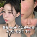 에녹스 | 인천 용현동 피부과 스킨보톡스 3cc 나비존 전/후 비교 &amp; 솔직후기 내돈내산