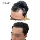 용인대버스정류장_M | 기흥두피문신 M자탈모 헤어라인 교정 자연스럽게 해결하는 방법 헤브랩스칼프에서