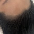 미헤어라인 이미지