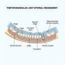 미소드림약국 | 이갈이 마우스피스 가격, 직접 사서 사용해 본 후기