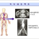 동맥경화증 및 복부대동맥류 원인 및 예방 자연치유 방법 이미지