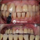 GR(음성군)-[장감로]-하-1 | "여기저기 없는 어금니 때문에 식사가 힘들어요." 음성 치과 추천 으로 임플란트 및 신경치료 후기