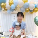 강원대학교병원 | 이소성몽고반점 레이저치료일기 prologue (+강원대학교병원)