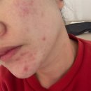 6311 | 봉선동 에스테틱 추천 여드름관리 잘하는 연아스킨랩 솔직후기 (광주 여드름 압출)