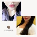 본디성형외과의원 | 서울 입술필러 '이렇게' 해야 자연스럽게 예뻐집니다.