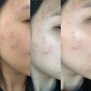 이룸병원 | [부천 상동 이룸뷰티] 비립종, 한관종, 편평사마귀 케어 내 돈 내산 찐 케어 후기 1회차 (관리...
