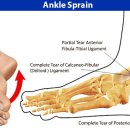 발목 염좌(Ankle Sprains) Ⅰ 이미지