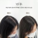 발산/까치산/화곡동 두피문신 20대 여자 가르마, 정수리 탈모커버 SMP 후기