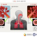 갱신형 천식진단비보장 특별약관 이미지