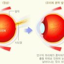 비문증(날파리증) 이미지