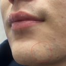 춘한의원 | 압구정 도산 피부과 - 남자친구 남성 레이저제모 2회차 후기 젠틀맥스프로플러스 (내돈내산)