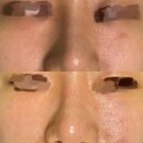 예솜의원 | 잠실새내피부과 리센츠피부과에서 mla레이저, 피코mla 모공 레이저 솔직 후기