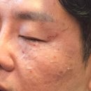 제주편평사마귀 제거 한의원 침으로 깔끔하게 지운 후기