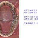 설측교정,돌출입교정,거미스마일 치료 교정 잘 하는 연치과의 &#34;어금니 브릿지가 있는 돌출입 환자의 설측교정&#34; 이미지