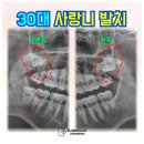 선단본치과의원 | 분당 30대 사랑니발치 실제 후기, 상악완전매복 사랑니치과 사례