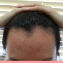 수헤어라인 이미지