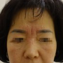 쁘띠2.7의원 | 광주 쁘띠2.7 미간 주름 필러, 보톡스 후기