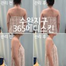 장신로L | 광주 수완지구 웨딩관리 &#39;365메디스킨&#39; 팔뚝 극초단파 업프팅 내돈내산 솔직후기