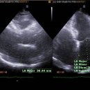 Left ventricular hypertrophy and Left Artial Enlargement 이미지