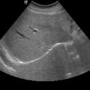 Hepatic hemangioma 이미지