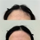 하에르뷰티 | 부평 하에르뷰티 얼굴왁싱후기(구렛나루,헤어라인,눈썹)