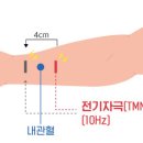 손목에 차는 '혈압 강하 의료기기' 나온다 이미지