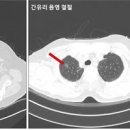 간유리음영이란? 원인 및 증상 이미지