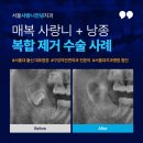 뿌리샘치과의원 | 매복 사랑니 낭종 동시 제거 수술 후기(ft. 함치성낭종)