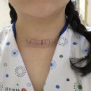 대승약국 | 갑상선 수술 후 첫 외래 및 흉터 기록 등등