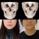 신경선 | 논현역 안면윤곽 2.5종 6개월 후기 :: 이중턱지흡, 심부볼제거, 아큐, 신경선후기까지
