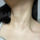 금은사우나 | 방배역 목 점빼기, 쥐젖제거 4개월차 후기 및 비용