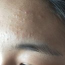 인진약국 | 초등학생 이마 좁쌀여드름 원인 중학생 여드름 화장품 흉터 연고 병행 후기