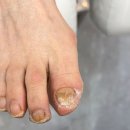 문제성 손, 발 오감네일 이미지