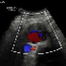 abdominal aortic aneurysm 이미지