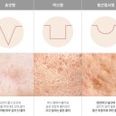 울산흉터전문피부과, 여드름 자국이 그대로였던 이유