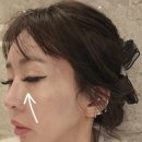 눈밑꺼짐 다크서클에는 역시, 림피드 시술? 후기 들고왔어요