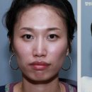 서울제일성형외과의원 네이버블로그