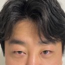 짝눈 때문에 받은 남자 안검하수 쌍꺼풀 수술, 내돈내산 솔직 후기!