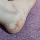 (주)페디플러스 네이버블로그