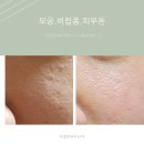인셀덤진천점 | 인셀덤으로 피부개선 어디까지 좋아질까? 모공 여드름 흉 기미 잡티 비립종 주름 안검하수 대전인셀덤...