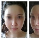 지방이식잘하는 곳 - MK성형외과