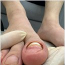 무드비네일닥터아이티엔내성발톱무좀발각질 이미지