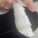 손가락 베였을때 정형외과 병원치료 공유 (찢어짐, 꼬맴, 병원비, 파상풍주사 )